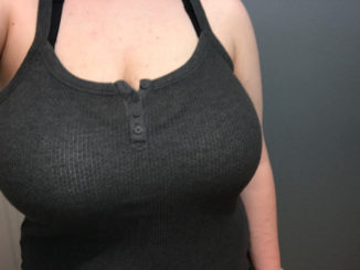 10 Advantages of Getting Breast Reduction Surgery