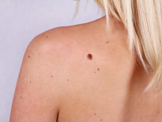 7 Ways to Get Rid of Skin Moles Naturally