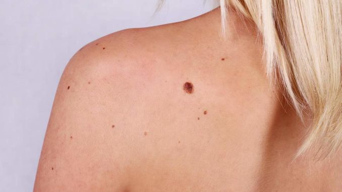 7 Ways to Get Rid of Skin Moles Naturally