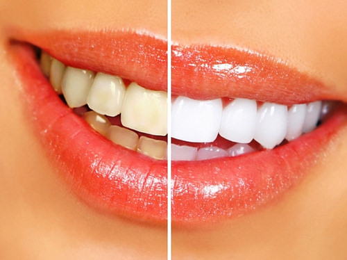 8 Reasons Why You Should Consider Having Your Teeth Whitened