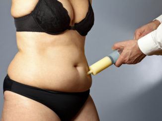 Benefits and Risks of Liposuction