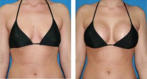 Breast Augmentation: Procedure and Recovery