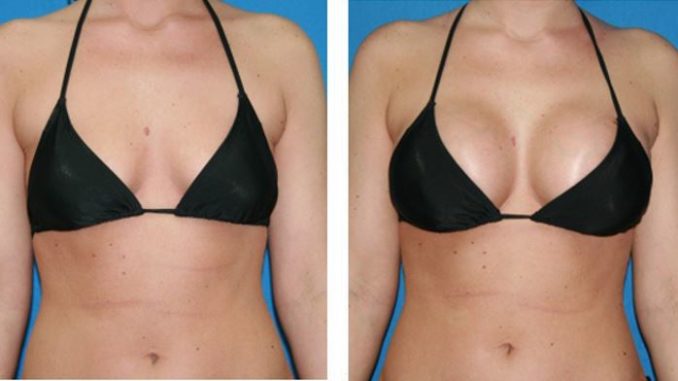 Breast Augmentation: Procedure and Recovery