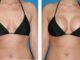 Breast Augmentation: Procedure and Recovery