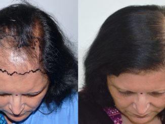 Getting To Know The Better Options For Hair Transplant Methods