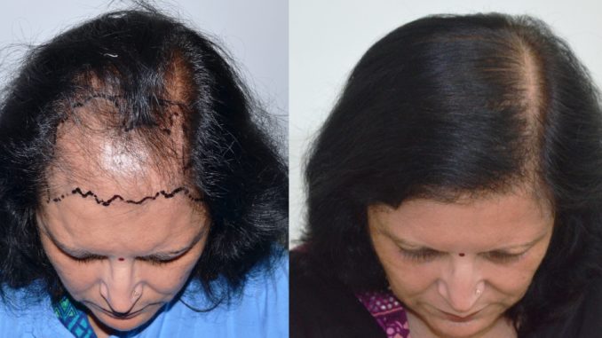 Getting To Know The Better Options For Hair Transplant Methods