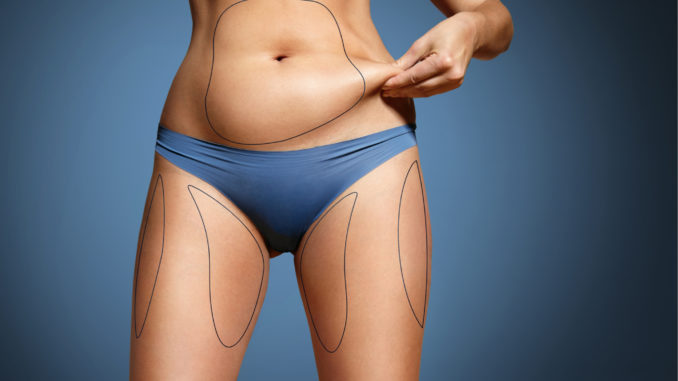 Preparing for Body Contouring Surgery after Extreme Weight Loss