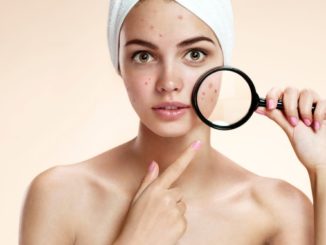 What are the Causes of Acne?