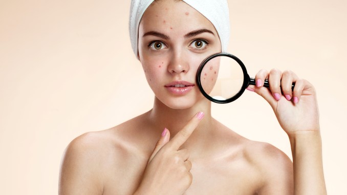 What are the Causes of Acne?