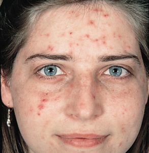 young woman with acne